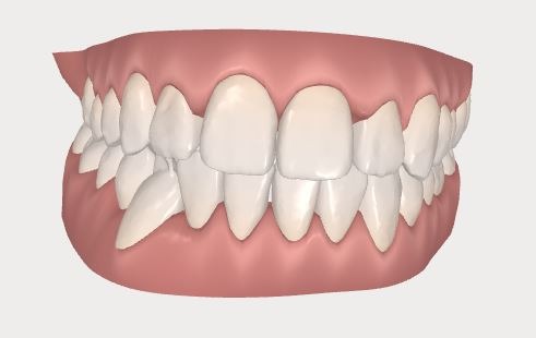 invisalign after scan