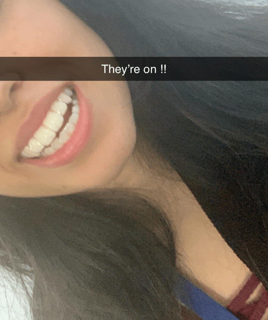 Invisalign day 1
